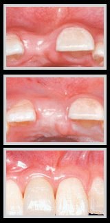 Sinus lift bone graft implant preparation healing result Ferrari Dental Clinic Beirut Lebanon Dr Habib Zarifeh