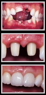 Socket preservation bone graft implant stages Ferrari Dental Clinic Beirut Lebanon Dr Habib Zarifeh