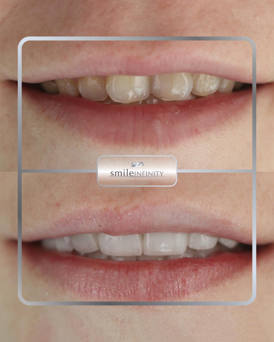 Composite veneers before and after female one session Smile Infinity Ferrari Dental Clinic Beirut Lebanon