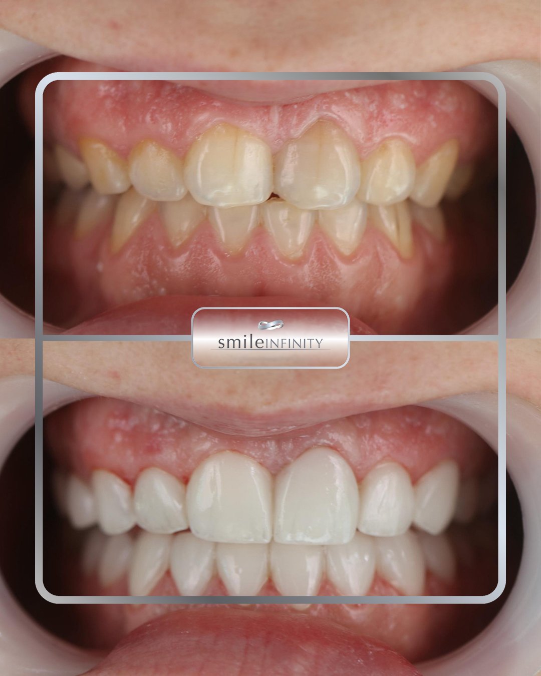 Composite veneers one session before and after retractor Ferrari Dental Clinic Beirut Lebanon Dr Habib Zarifeh