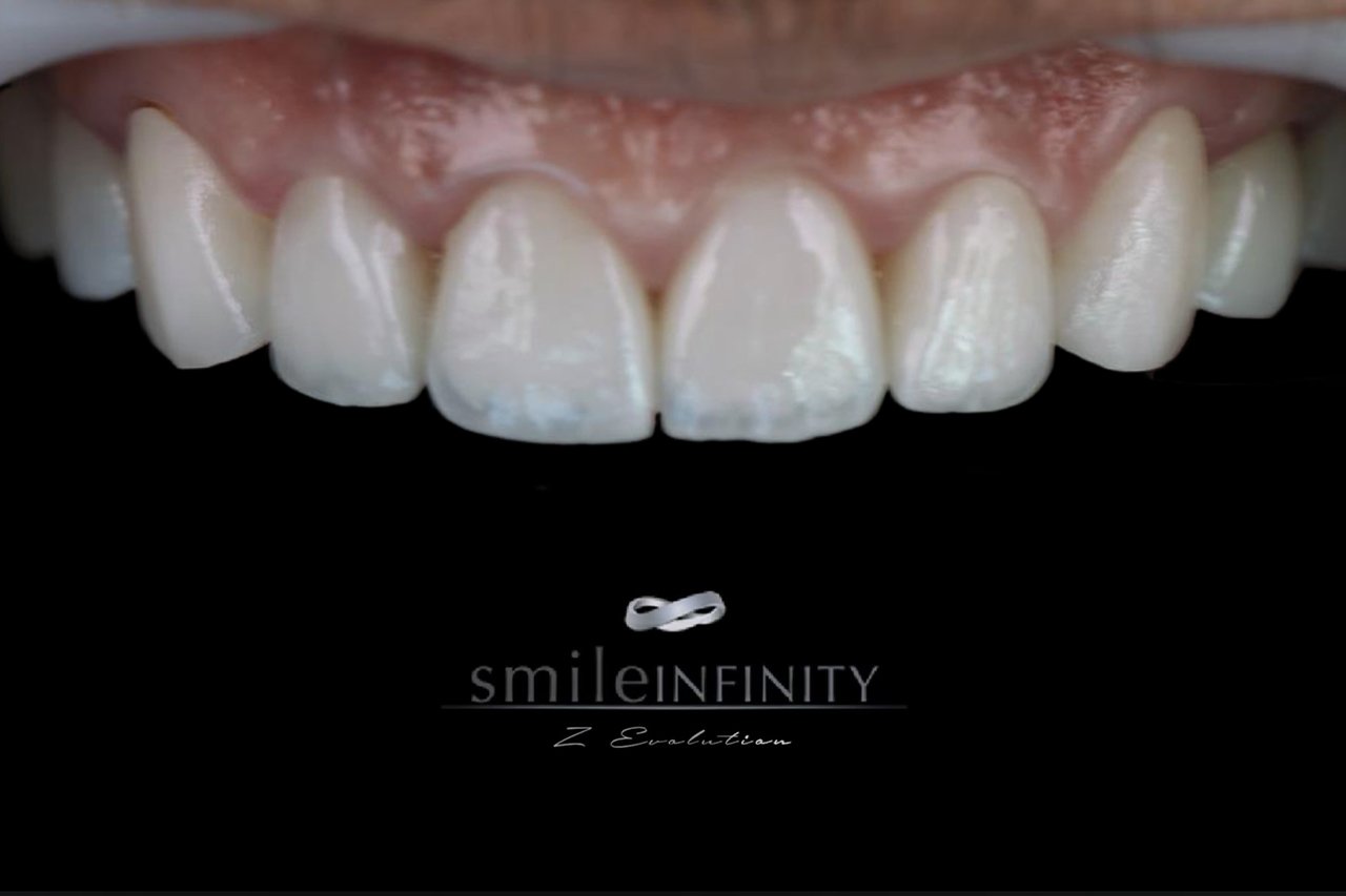 Composite veneers result one session Smile Infinity Ferrari Dental Clinic Beirut Lebanon Dr Habib Zarifeh