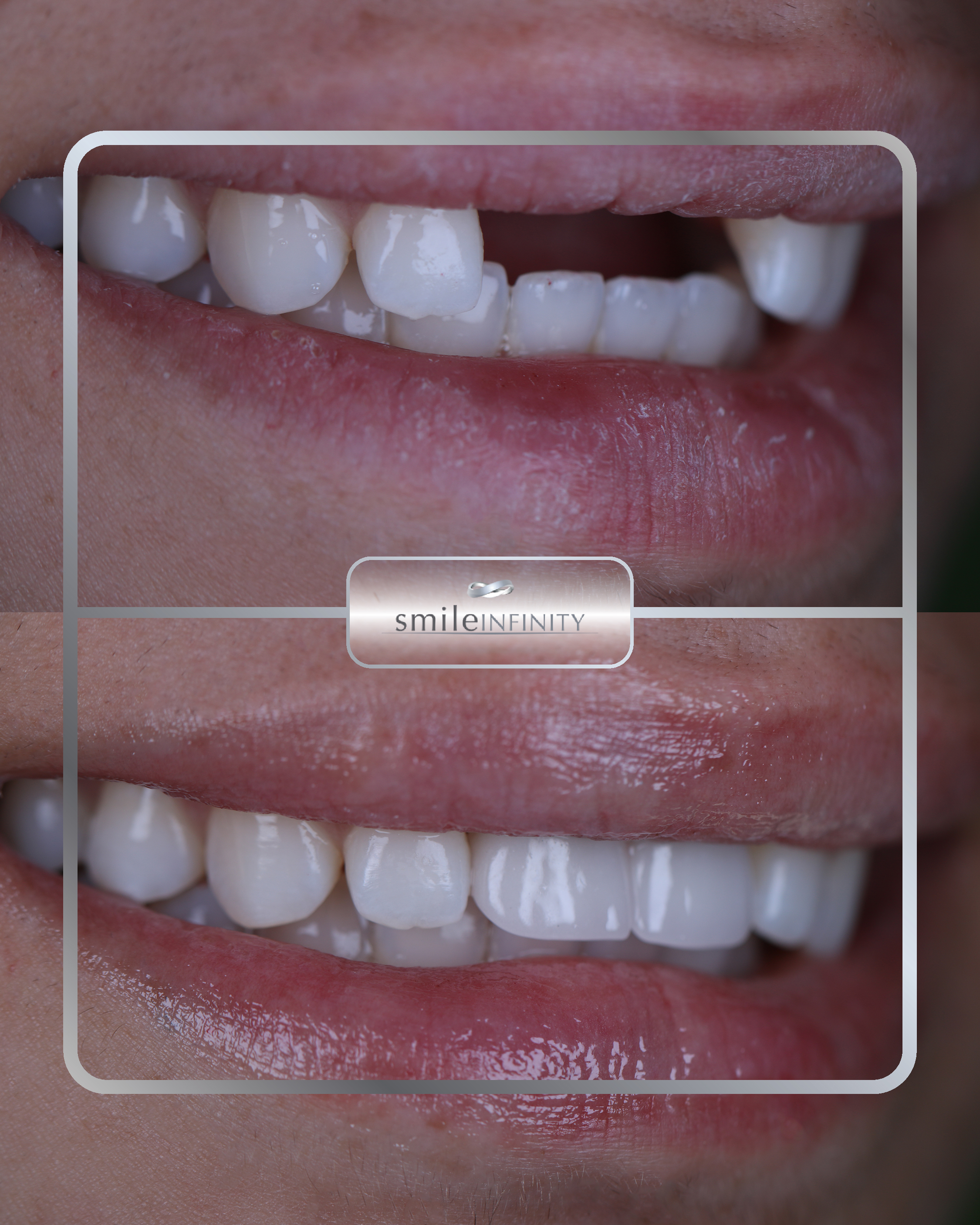 Laser assisted dental implant before and after female — Ferrari Dental Clinic Lebanon Dr Habib Zarifeh Waterlase
