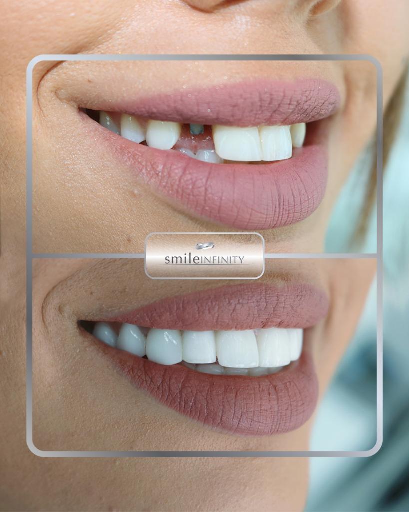 Dental implant with crown Hollywood Smile before and after female — Smile Infinity Ferrari Dental Clinic Beirut Lebanon
