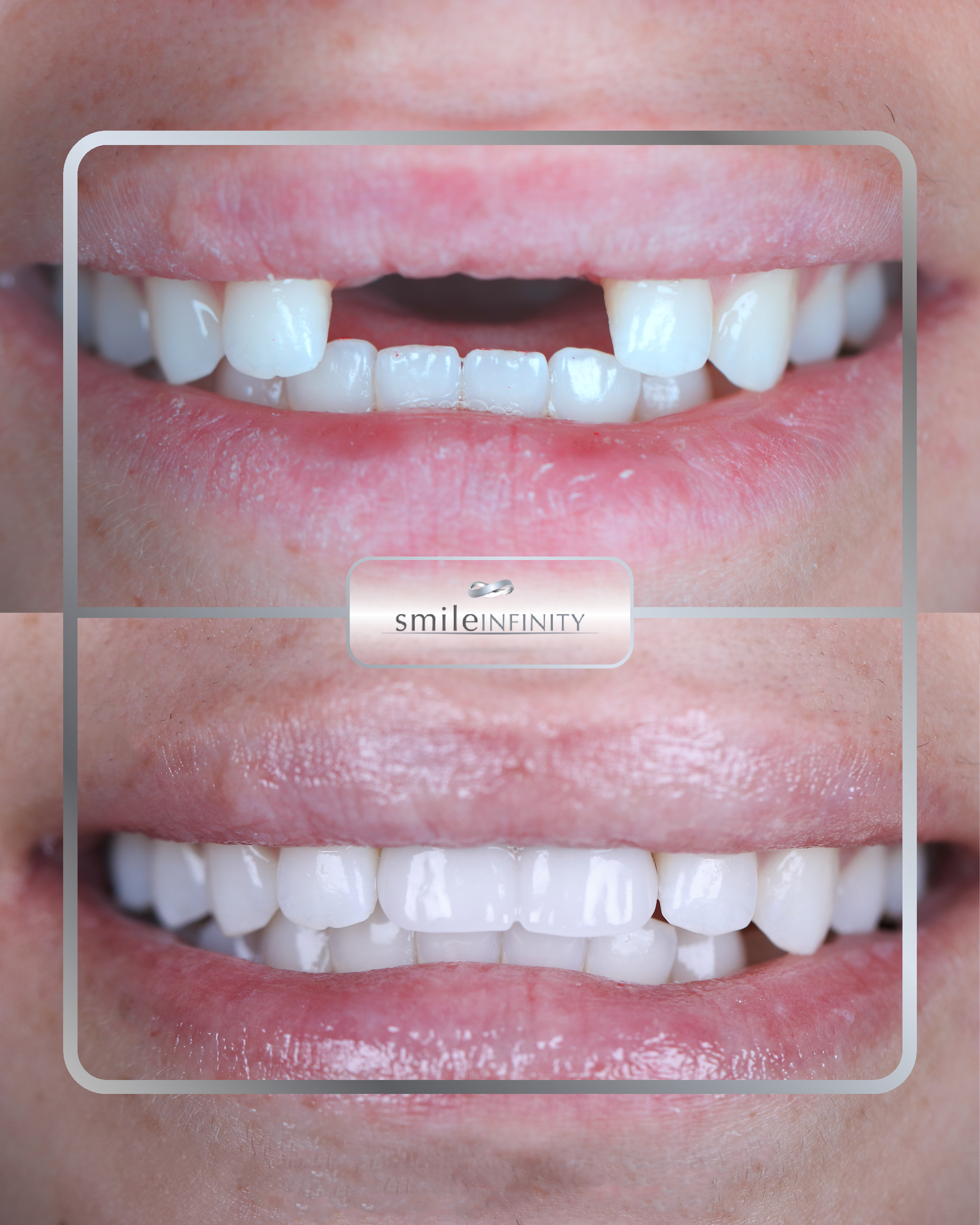 Dental implant full arch before and after Ferrari Dental Clinic Beirut Lebanon