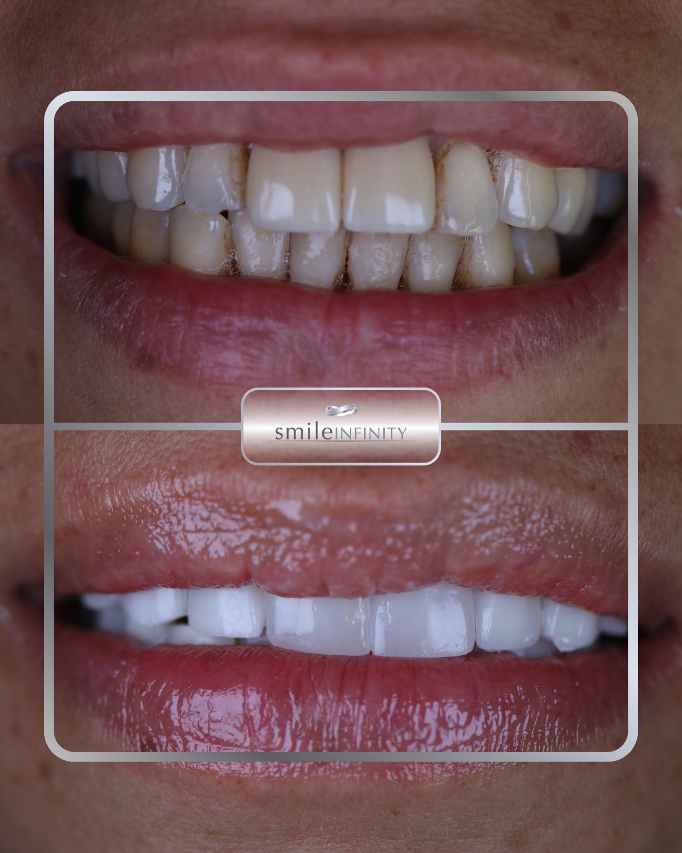 Emax ceramic veneers before and after female Smile Infinity Ferrari Dental Clinic Beirut Lebanon Dr Habib Zarifeh