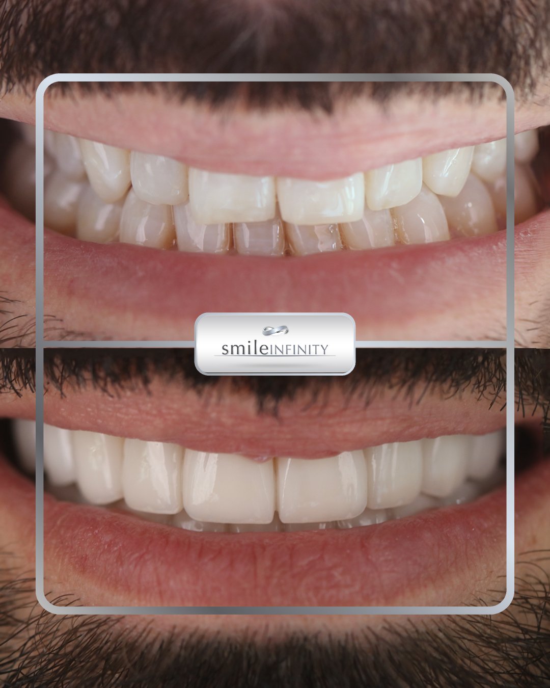 Emax veneers CAD CAM before and after front view Smile Infinity Beirut Lebanon Ferrari Dental Clinic