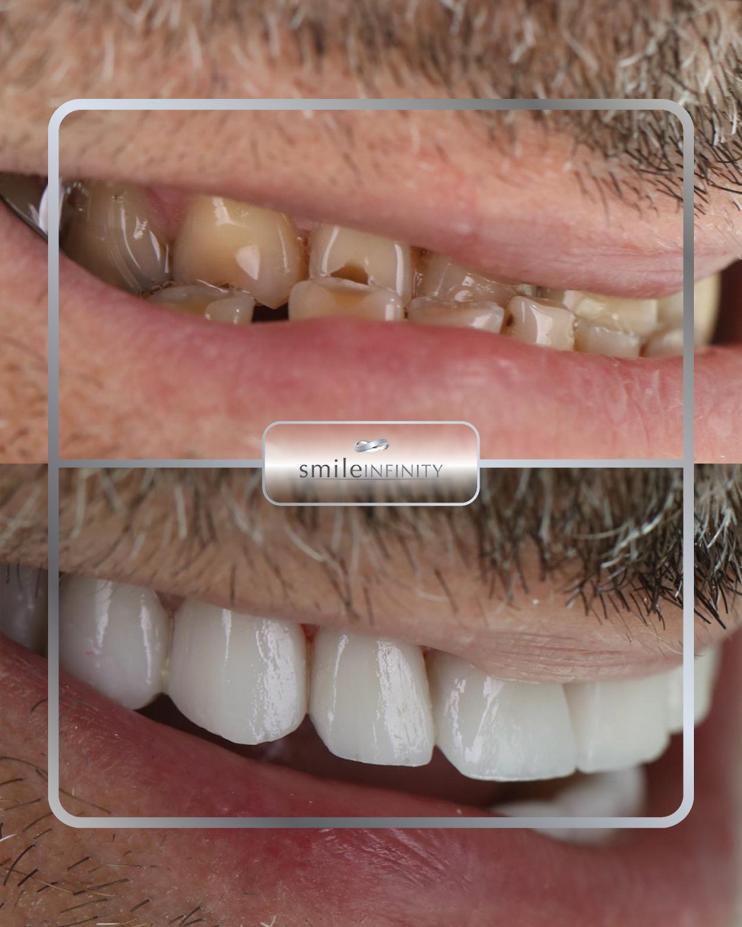 Emax veneers complex restoration severely compromised teeth before and after Dr Habib Zarifeh Beirut Lebanon Ferrari Dental Clinic