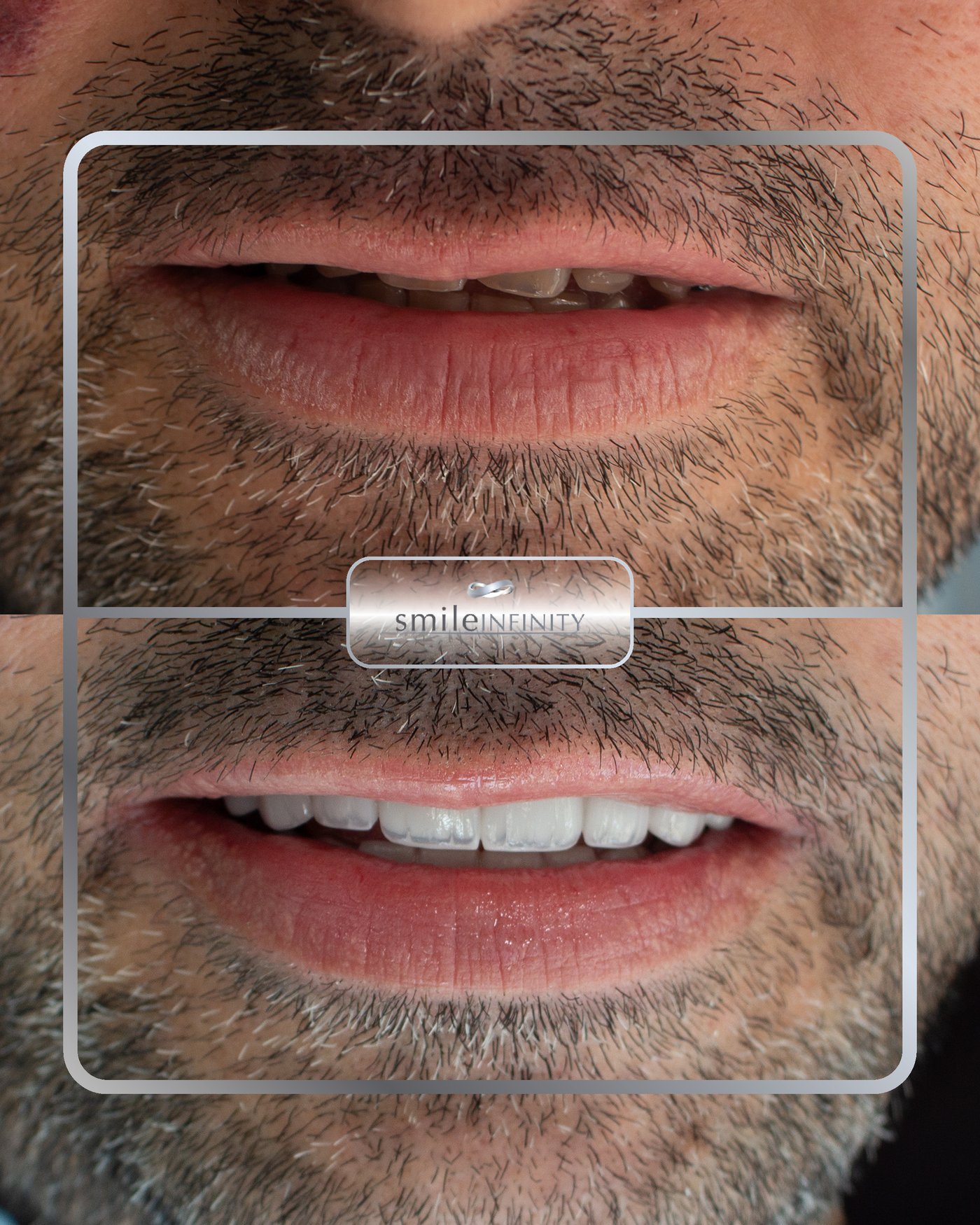 Emax veneers Hollywood Smile before and after male Ferrari Dental Clinic Beirut Lebanon Dr Habib Zarifeh
