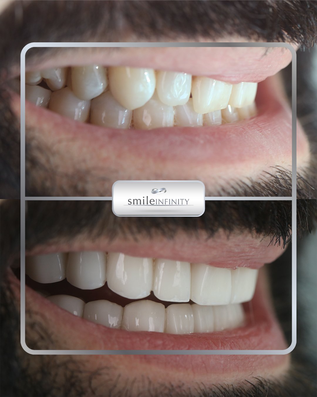 Emax veneers lateral view before and after Dr Habib Zarifeh Lebanon Ferrari Dental Clinic