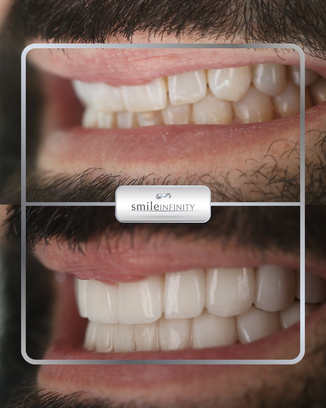 Emax veneers side view before and after Smile Infinity Ferrari Dental Clinic Lebanon