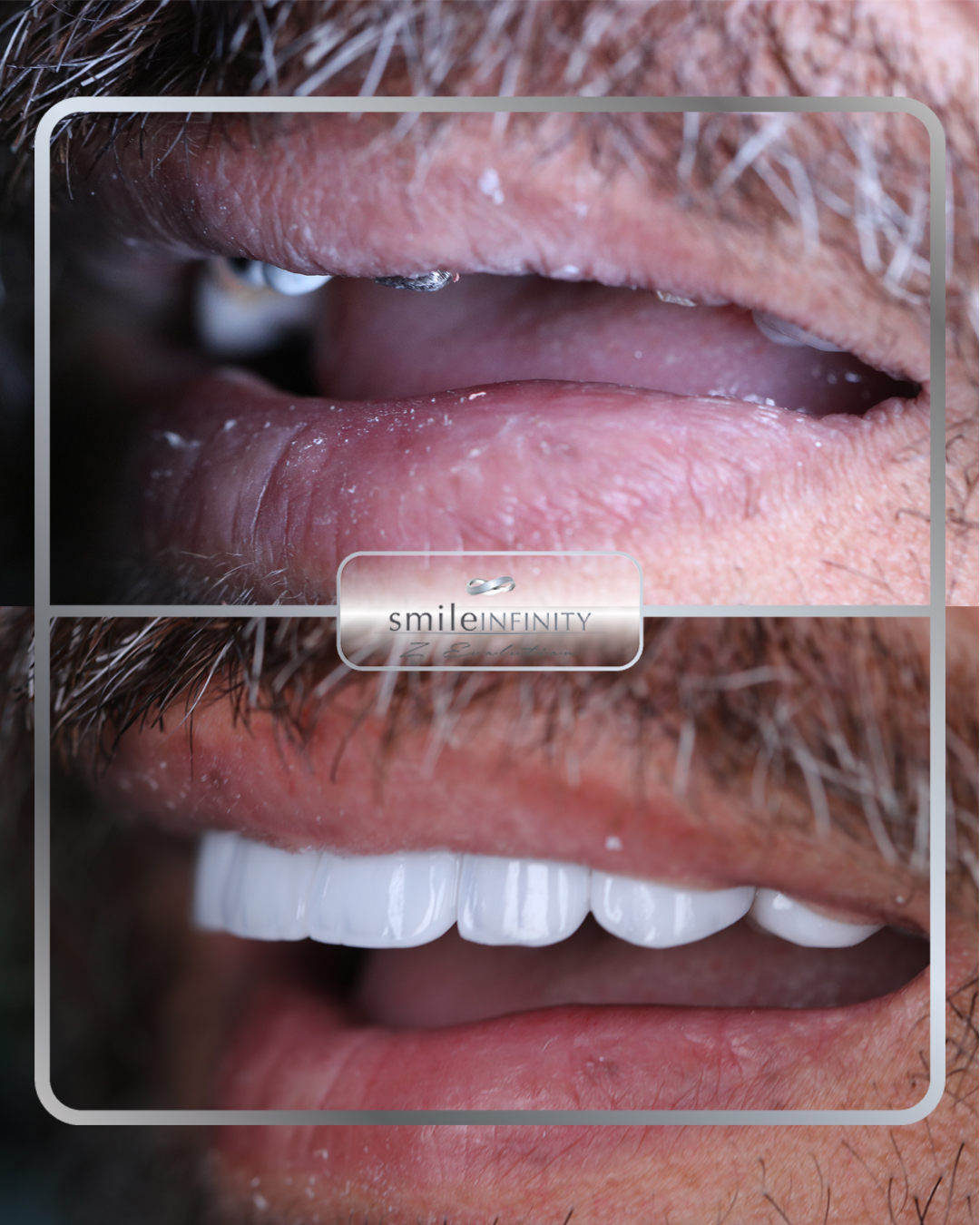 Full arch implant rehabilitation All-on-4 before and after male — Dr Habib Zarifeh Ferrari Dental Clinic Beirut Lebanon