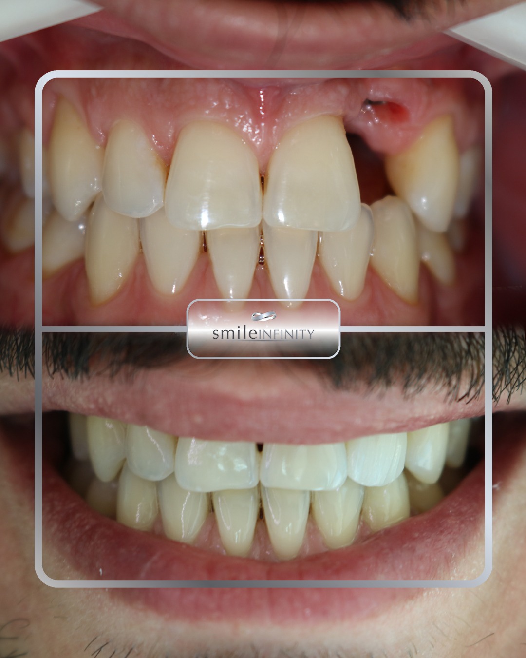 Full mouth rehabilitation implants before and after male — Dr Habib Zarifeh Smile Infinity Beirut Lebanon