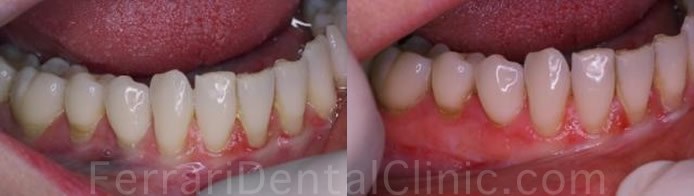 Multiple recession full arch gum graft before and after lower arch Smile Infinity Ferrari Dental Clinic Beirut Lebanon