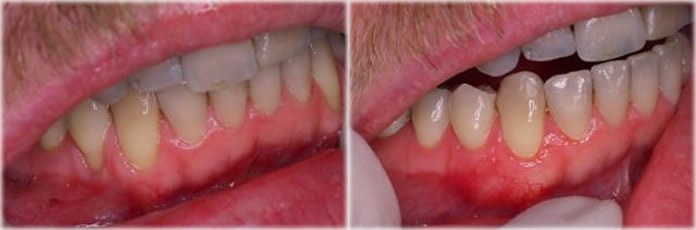 Gum graft connective tissue graft before and after lower teeth recession Ferrari Dental Clinic Beirut Lebanon Dr Habib Zarifeh