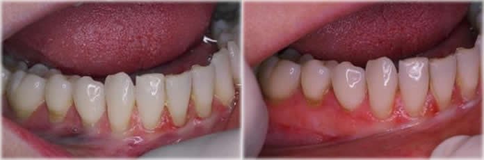 Free gingival graft keratinised gum tissue before and after Ferrari Dental Clinic Lebanon Dr Habib Zarifeh