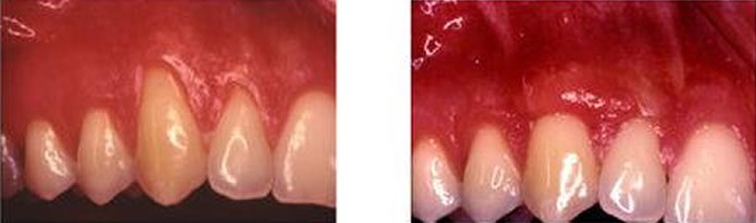 Laser assisted gum graft root coverage before and after Ferrari Dental Clinic Beirut Lebanon Waterlase Dr Habib Zarifeh