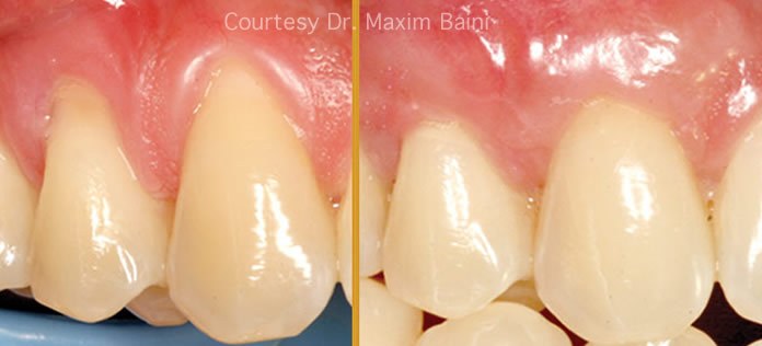 Tunnel technique gum graft soft tissue augmentation before and after Dr Habib Zarifeh Beirut Lebanon Ferrari Dental Clinic