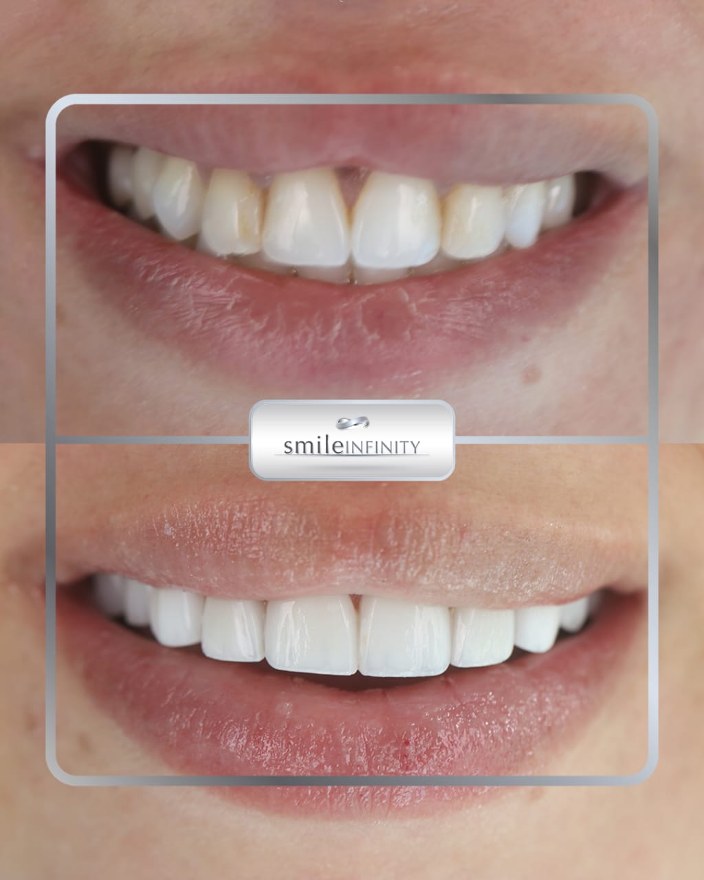 Lumineers by Cerinate no drilling before and after female Smile Infinity Ferrari Dental Clinic Beirut Lebanon