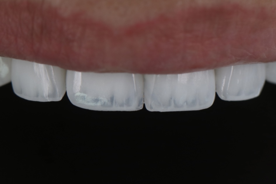 Lumineers by Cerinate close-up — no-prep porcelain veneers Ferrari Dental Clinic Beirut Lebanon Dr Habib Zarifeh