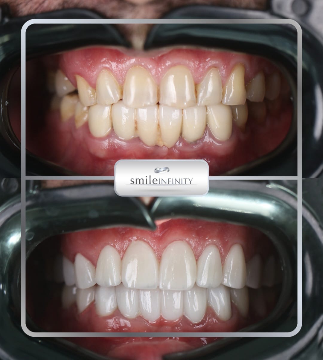 Lumineers full arch before and after retractor Smile Infinity Beirut Lebanon Ferrari Dental Clinic