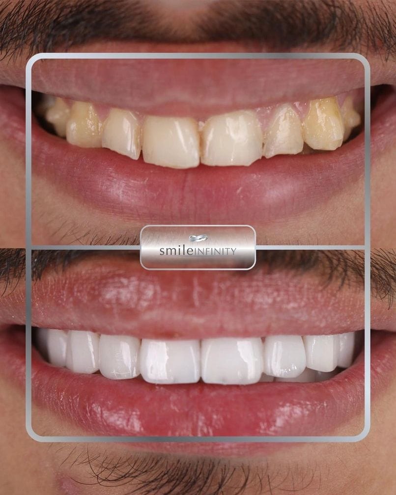 Lumineers Hollywood Smile full before and after male Dr Habib Zarifeh Beirut Lebanon Ferrari Dental Clinic