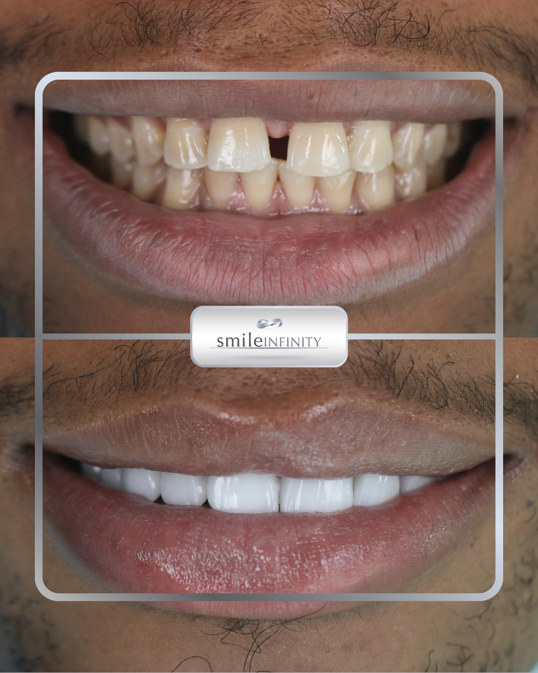 Lumineers gap closure before and after male Smile Infinity Ferrari Dental Clinic Lebanon Dr Habib Zarifeh