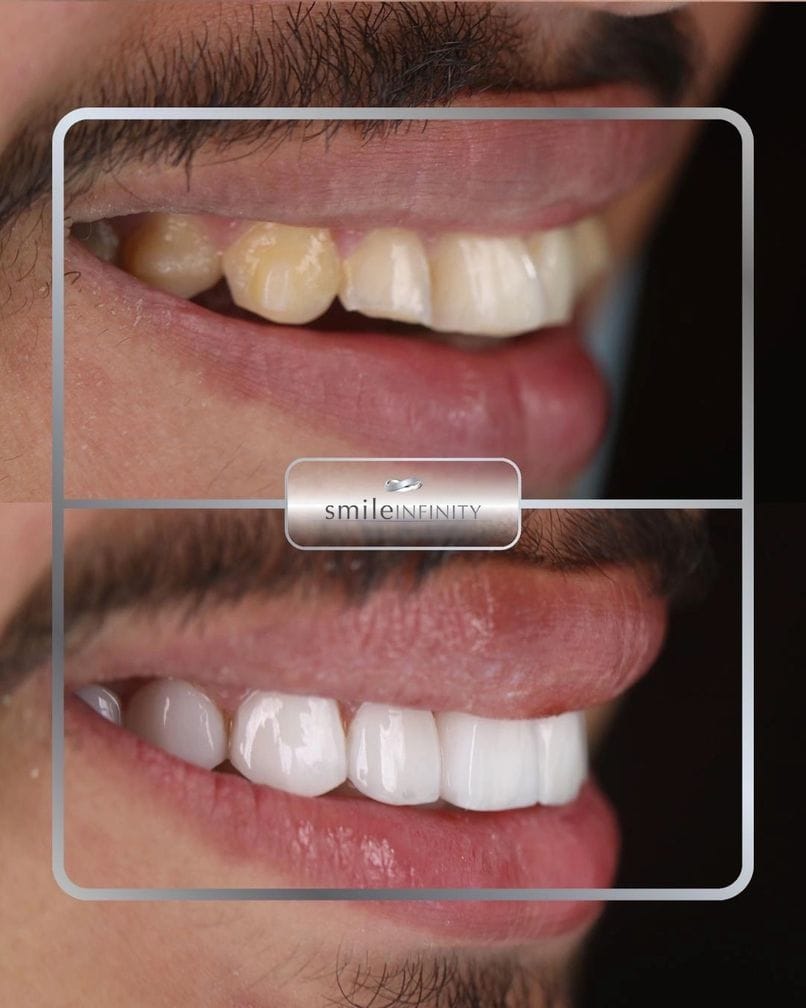 Lumineers Hollywood Smile before and after male Smile Infinity Lebanon Dr Habib Zarifeh Ferrari Dental Clinic