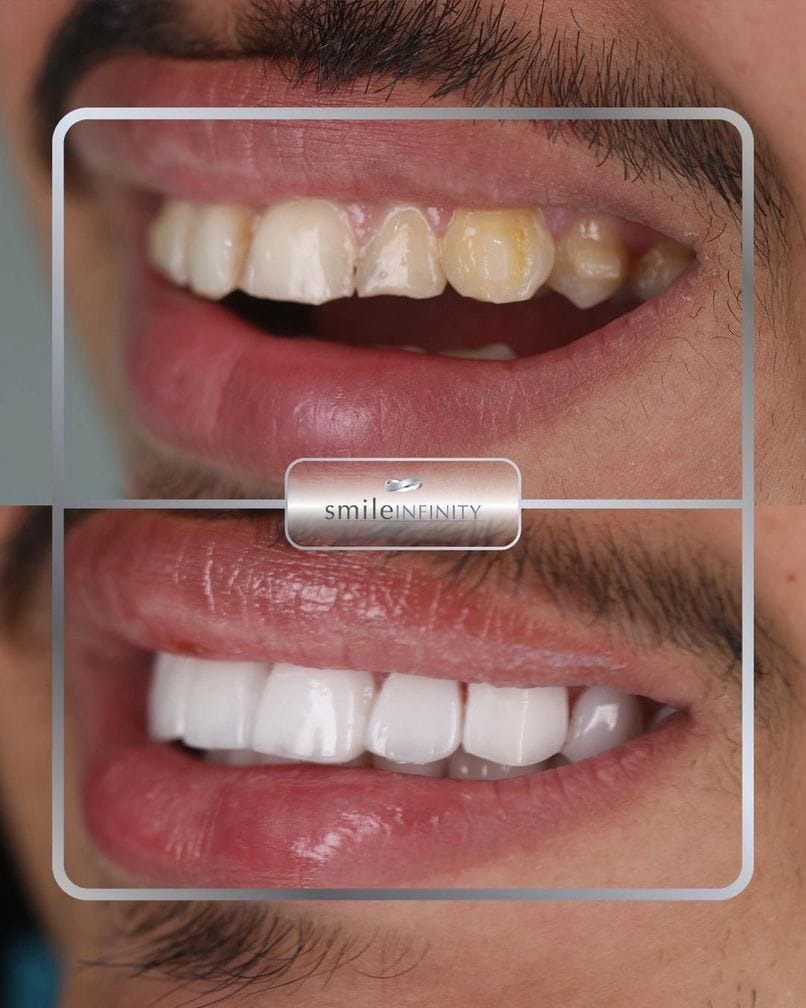 Lumineers no-prep veneers before and after male Ferrari Dental Clinic Beirut Lebanon Dr Habib Zarifeh