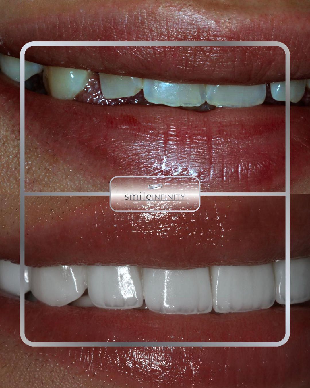 Lumineers porcelain veneers before and after female Ferrari Dental Clinic Lebanon Dr Habib Zarifeh