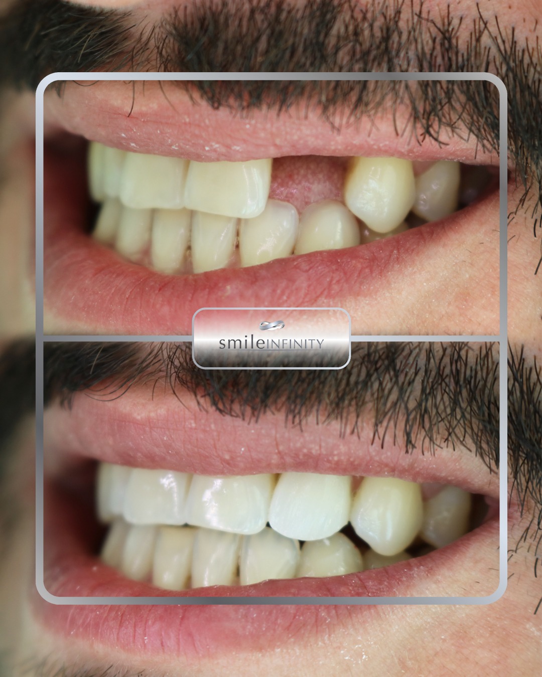 Missing tooth dental implant before and after male — Smile Infinity Lebanon Dr Habib Zarifeh Ferrari Dental Clinic