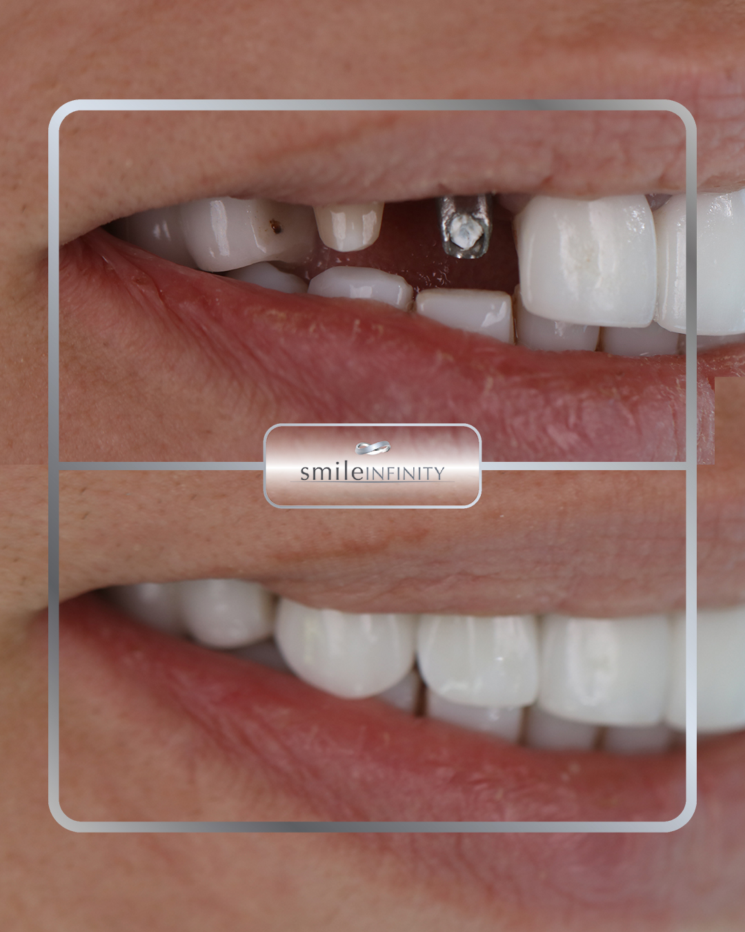 One Day Implant® before and after — single tooth implant Ferrari Dental Clinic Beirut Lebanon Dr Habib Zarifeh