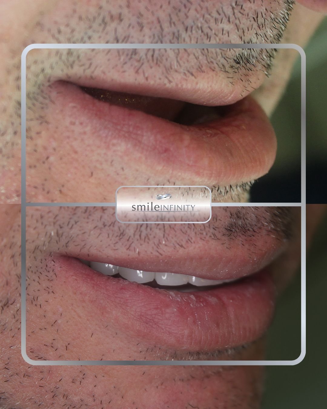 Oral surgery full arch restoration before and after male Ferrari Dental Clinic Lebanon Dr Habib Zarifeh