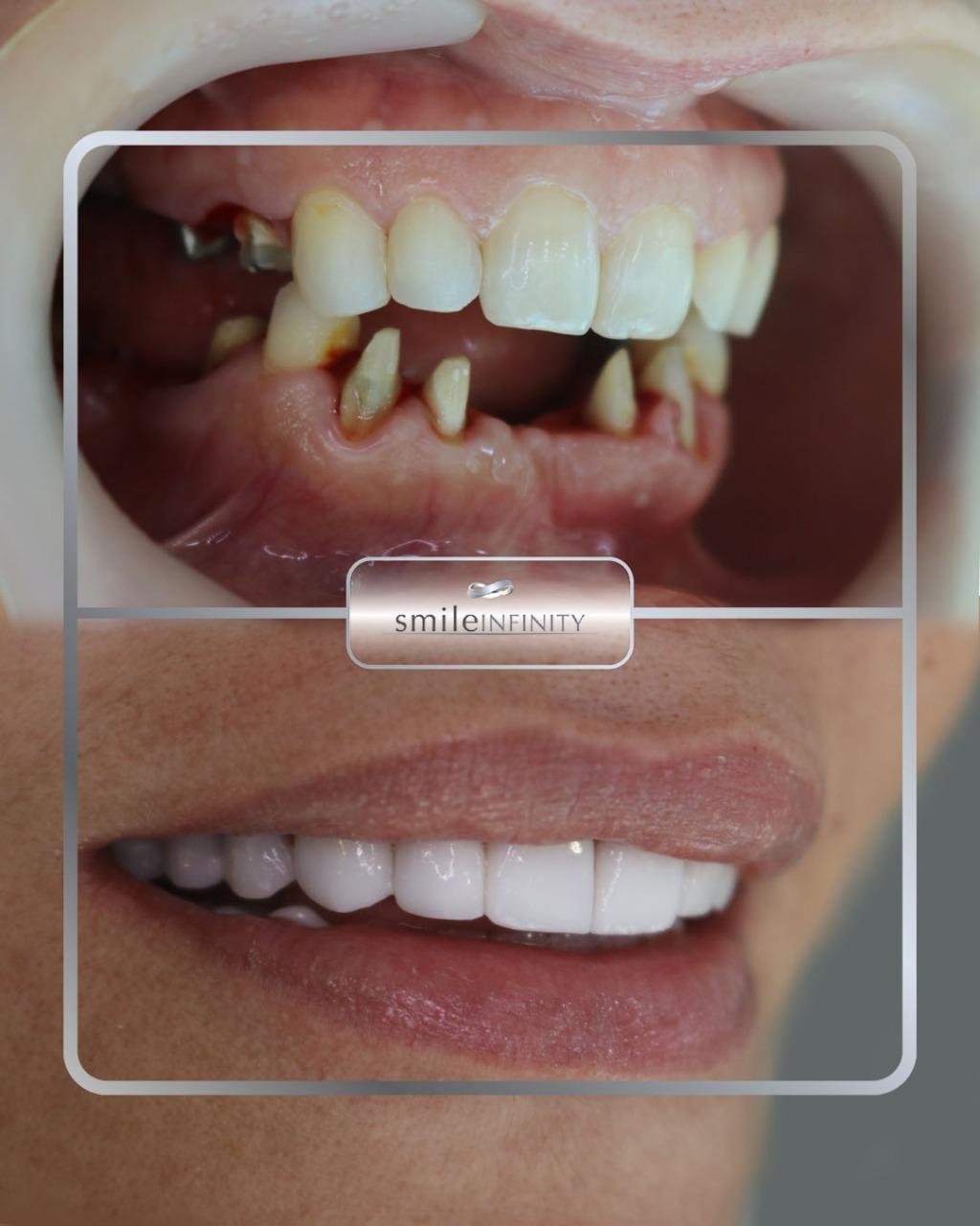 Full mouth rehabilitation oral surgery before and after female Ferrari Dental Clinic Beirut Lebanon Dr Habib Zarifeh Smile Infinity
