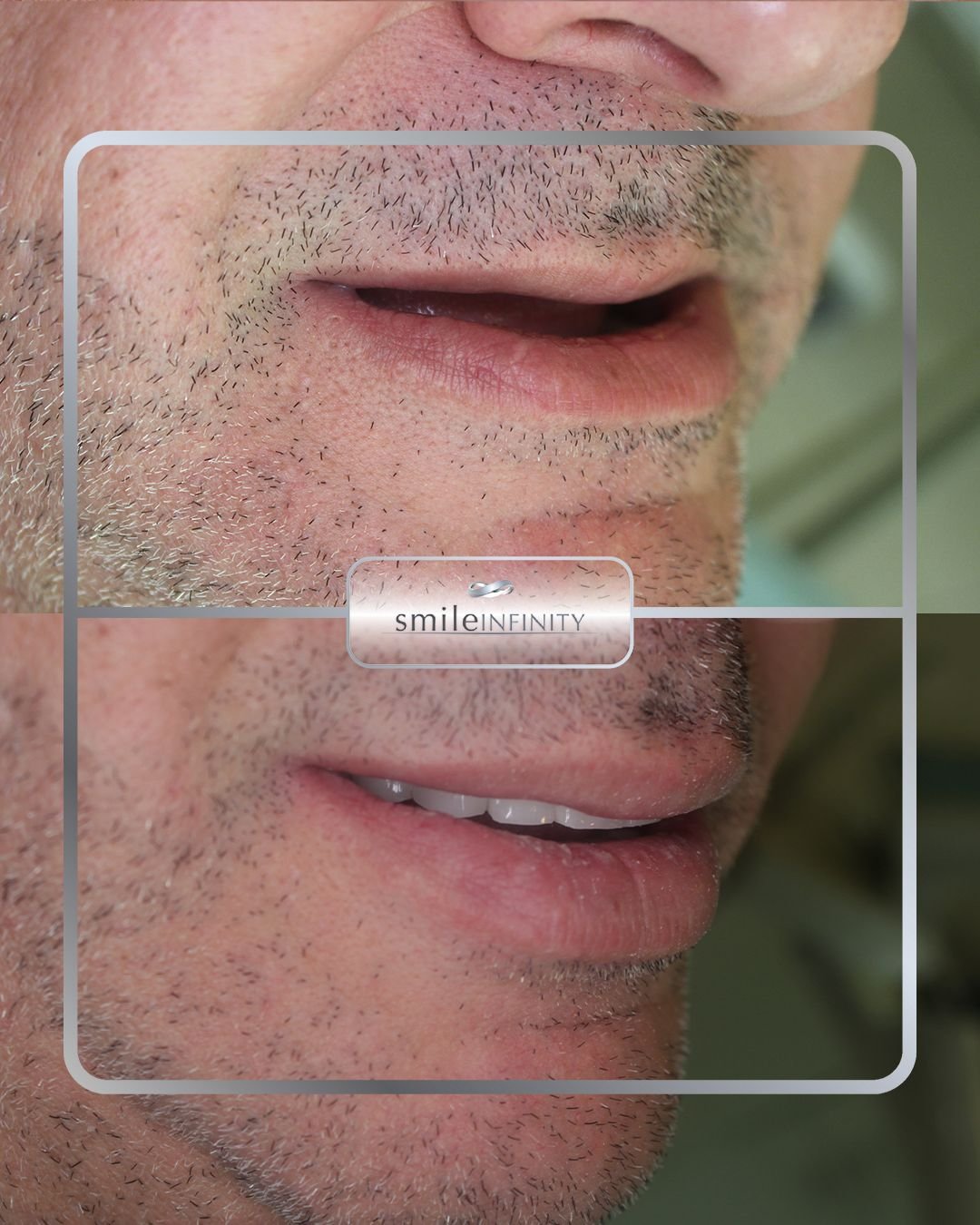 Oral surgery implant restoration before and after male Smile Infinity Beirut Lebanon Ferrari Dental Clinic Dr Habib Zarifeh