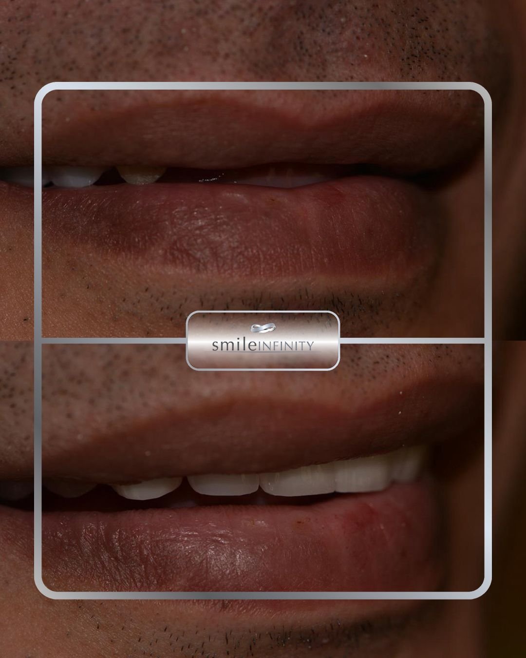 Pre-implant surgical preparation missing teeth before and after international patient Smile Infinity Ferrari Dental Clinic Lebanon