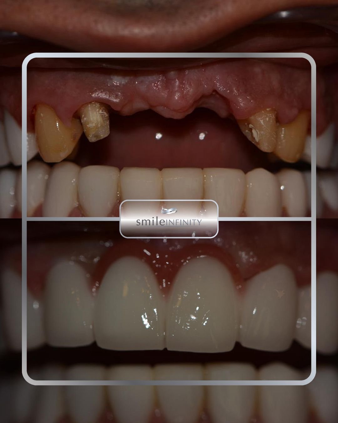Severely compromised dentition full mouth oral surgery before and after Ferrari Dental Clinic Beirut Lebanon Dr Habib Zarifeh