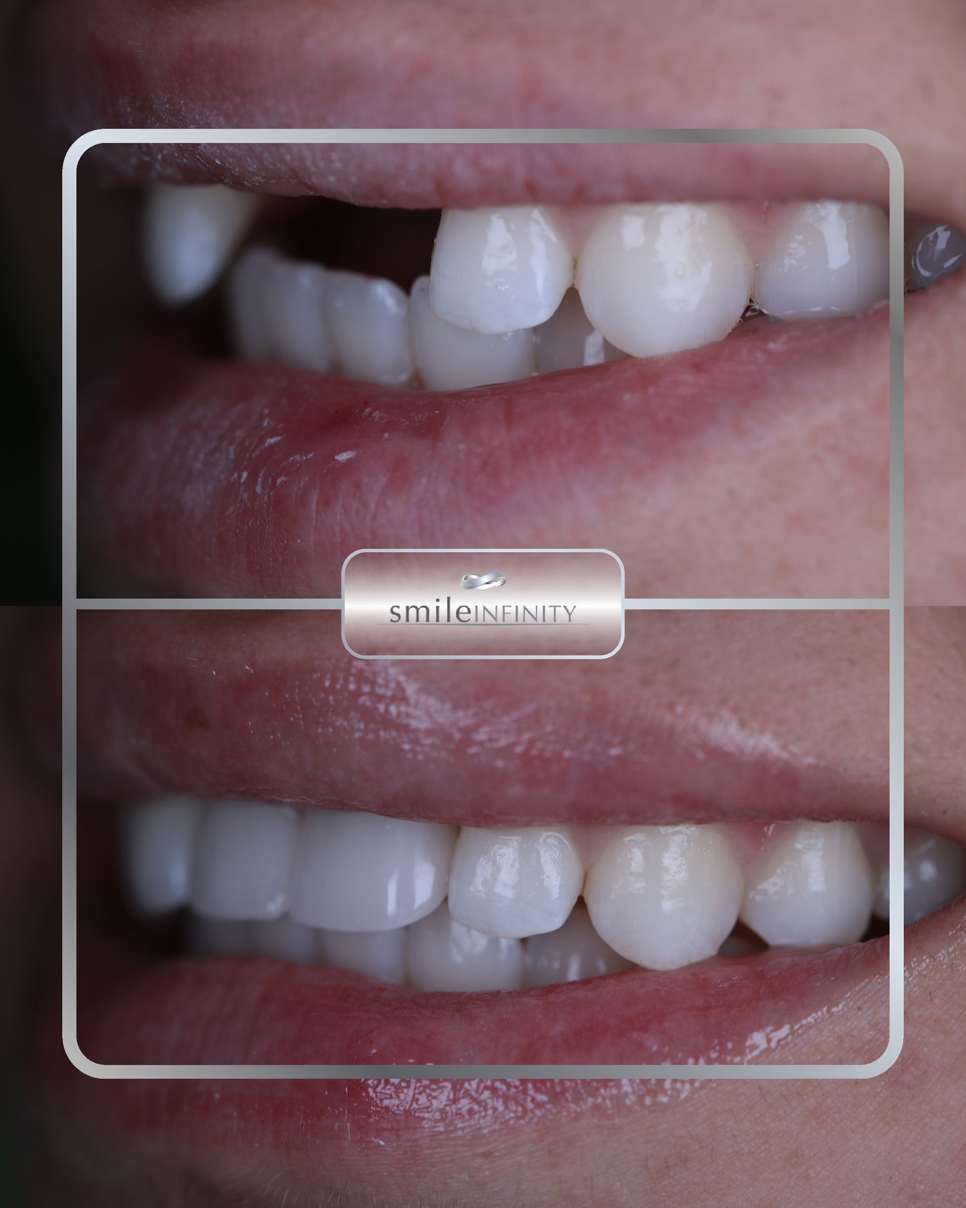 Aesthetic gum surgery single implant before and after female Ferrari Dental Clinic Beirut Lebanon Dr Habib Zarifeh