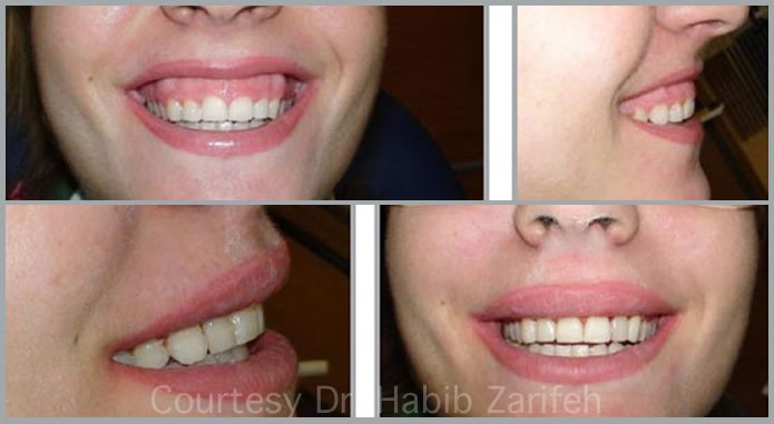 Waterlase laser gummy smile correction before and after Dr Habib Zarifeh Beirut Lebanon Ferrari Dental Clinic