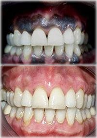 Waterlase laser melanin removal gum depigmentation before and after Ferrari Dental Clinic Beirut Lebanon Dr Habib Zarifeh