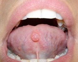 Waterlase laser soft tissue biopsy oral pathology papilloma Ferrari Dental Clinic Lebanon Dr Habib Zarifeh