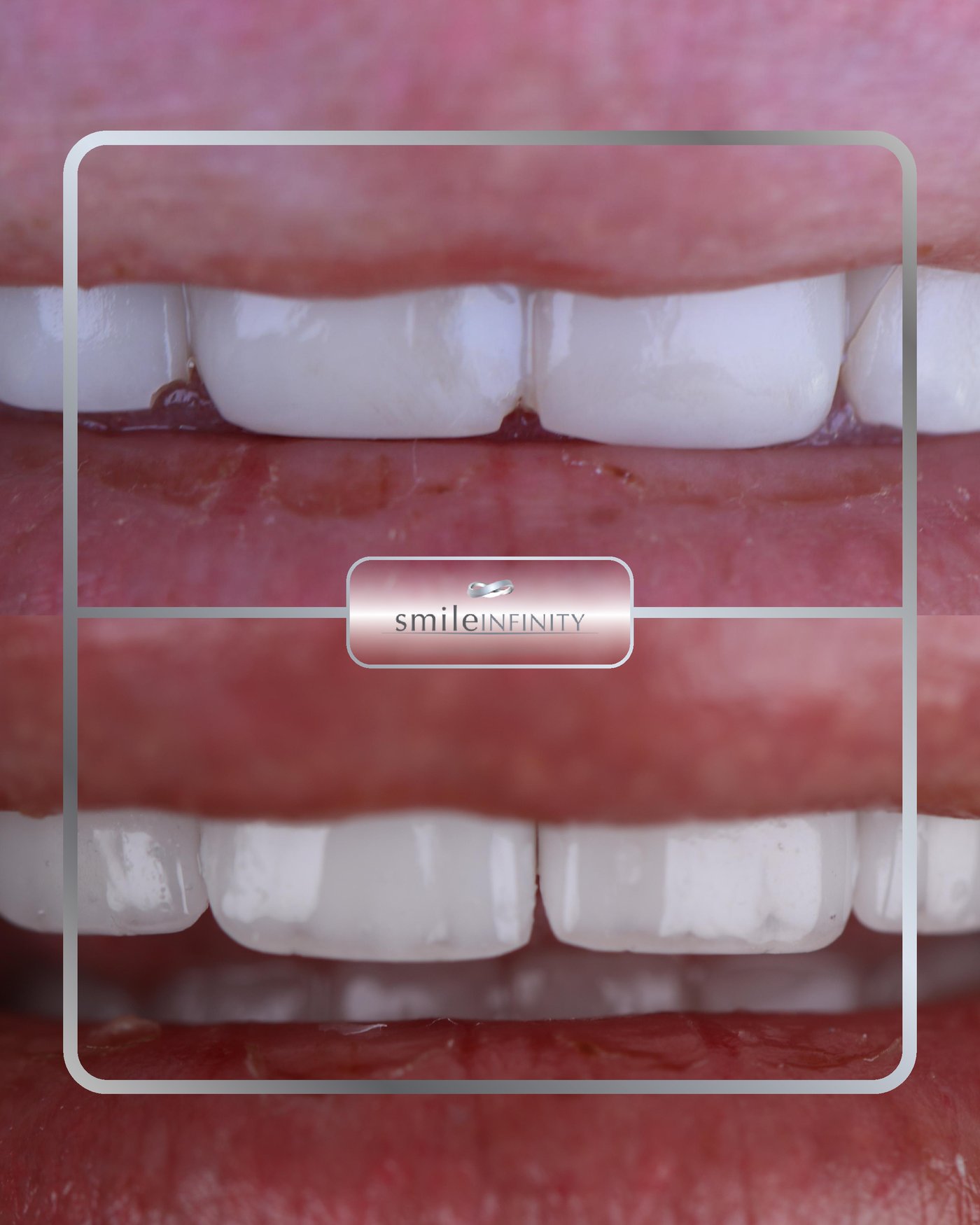 ZEvolution Veneers before and after female Ferrari Dental Clinic Beirut Lebanon Dr Habib Zarifeh German ceramic