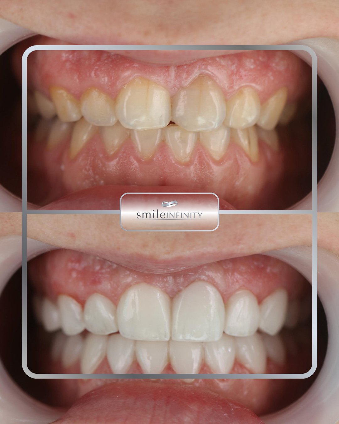 ZEvolution Veneers zero preparation clinical retractor before and after Smile Infinity Beirut Lebanon Ferrari Dental Clinic