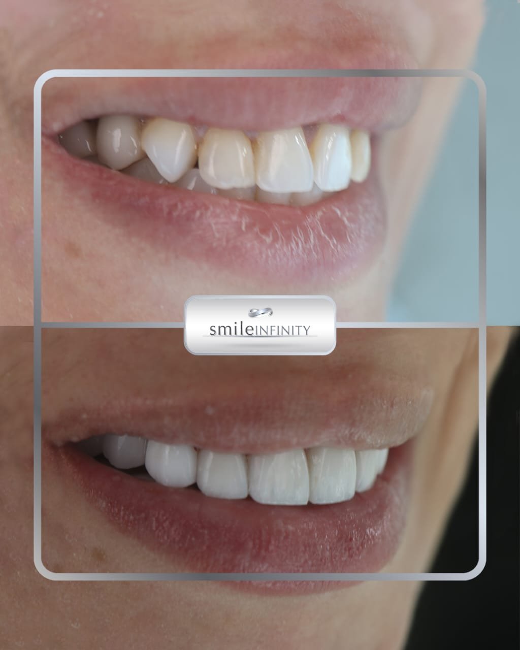 ZEvolution Veneers no-prep before and after female Dr Habib Zarifeh Lebanon Smile Infinity Ferrari Dental Clinic