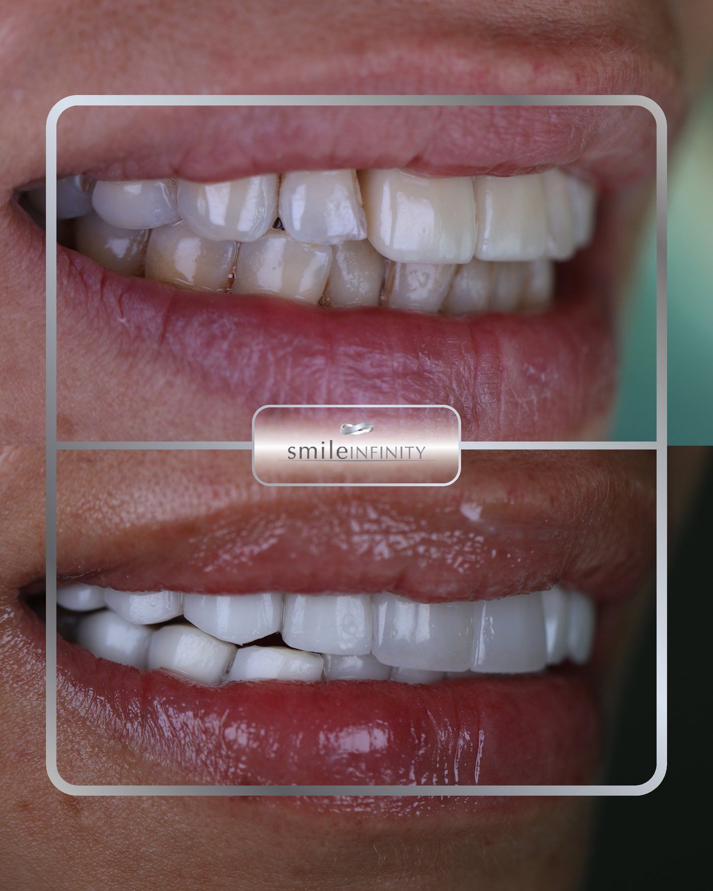 ZEvolution Veneers smile transformation before and after Ferrari Dental Clinic Lebanon Dr Habib Zarifeh AADEC Dubai 2024